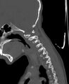 Butterfly vertebra (Radiopaedia 77903-90209 Sagittal bone window 23).jpg