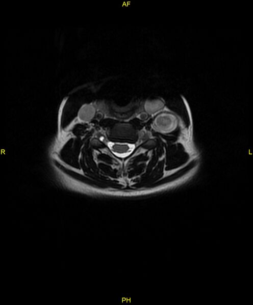 File:C5 nerve sheath tumor (Radiopaedia 85777-101596 Axial T2 38).jpg