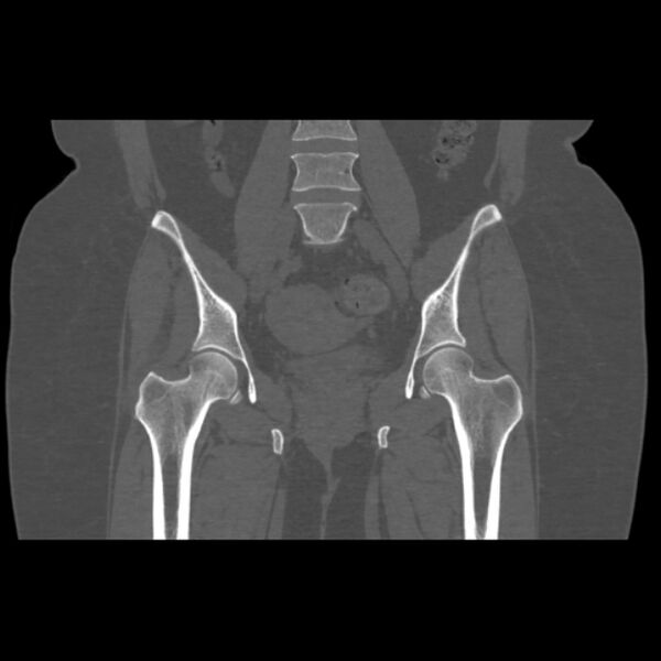 File:Calcific tendinitis of the gluteus medius muscle (Radiopaedia 66998-76318 Coronal bone window 30).jpg