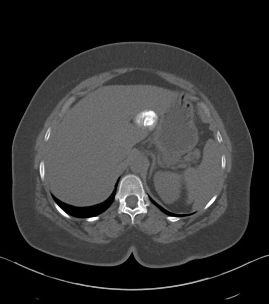 File:Calcified hepatic hydatid cyst (Radiopaedia 81127-94738 Axial non-contrast 23).jpg