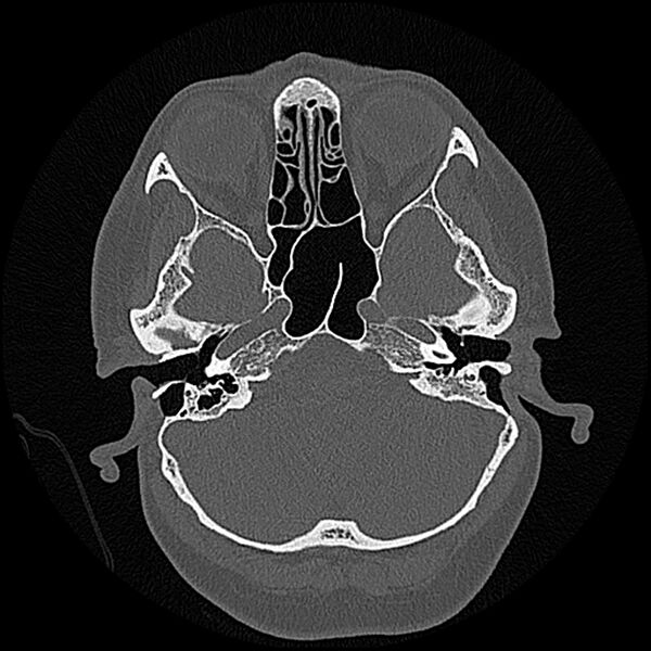 File:Canal up mastoidectomy (Radiopaedia 78108-90638 Axial bone window 60).jpg