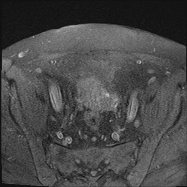 File:Cancer cervix - stage IIb (Radiopaedia 75411-86615 T1 fat sat 22).jpg
