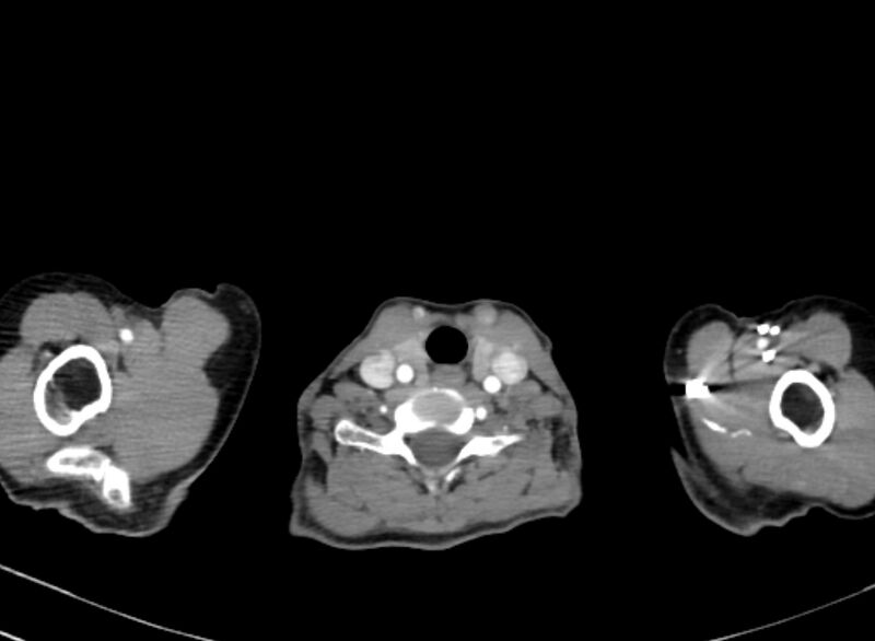 File:Cannonball metastases from breast cancer (Radiopaedia 91024-108569 A 3).jpg