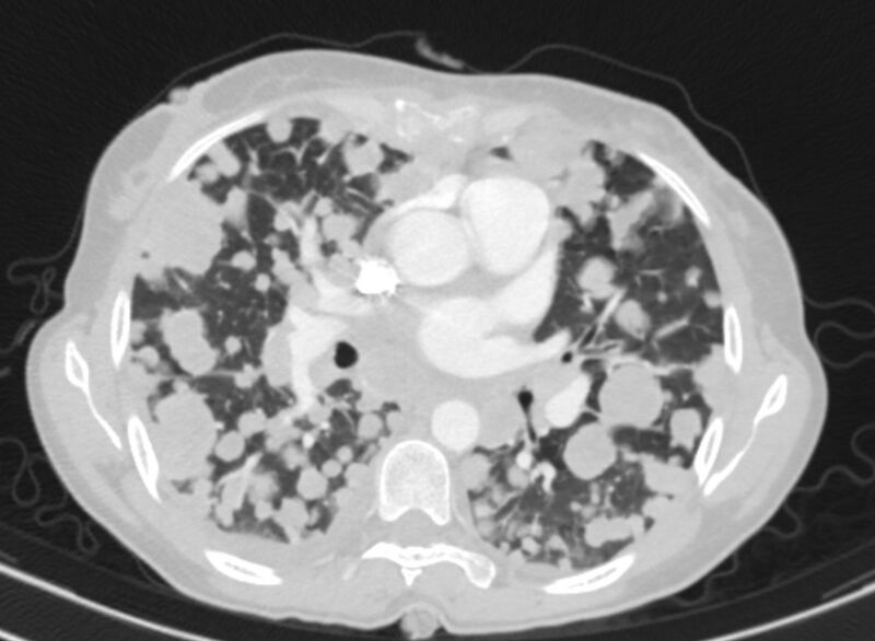 File:Cannonball metastases from breast cancer (Radiopaedia 91024-108569 Axial lung window 48).jpg