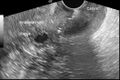 Carcinoma of the cervix - squamous cell (Radiopaedia 30432-31097 B 1).jpg