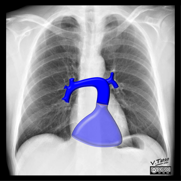 File:Cardiomediastinal anatomy on chest radiography (annotated images) (Radiopaedia 46331-50742 G 1).png