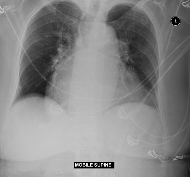 File:Cardiomegaly with left atrial enlargement (Radiopaedia 34055).png