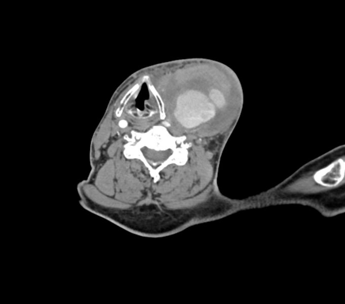 File:Carotid artery pseudoaneurysm (Radiopaedia 84030-99259 C 51).jpg