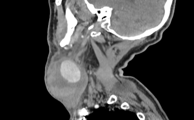 File:Carotid artery pseudoaneurysm (Radiopaedia 84030-99259 E 41).jpg