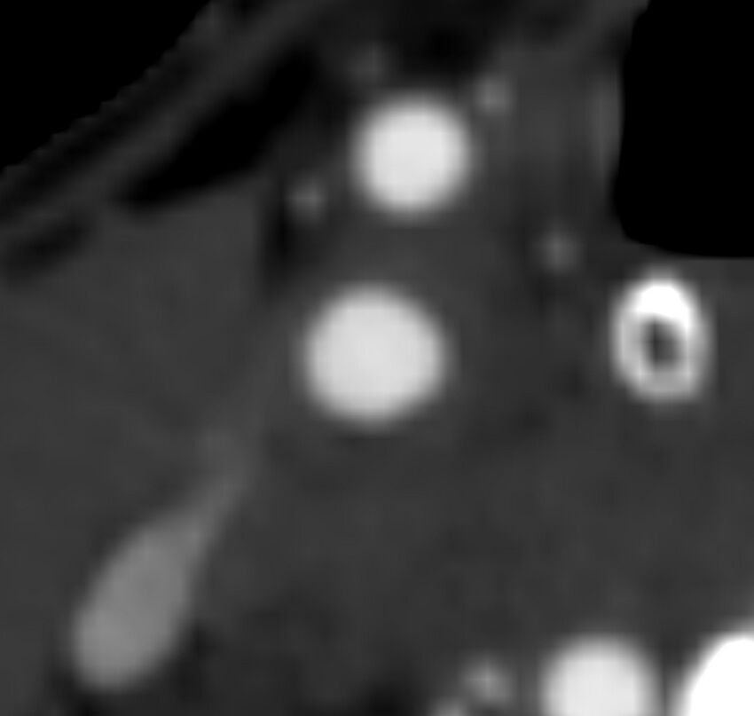 Carotid near-occlusion (Radiopaedia 85304-100887 M 51).jpg