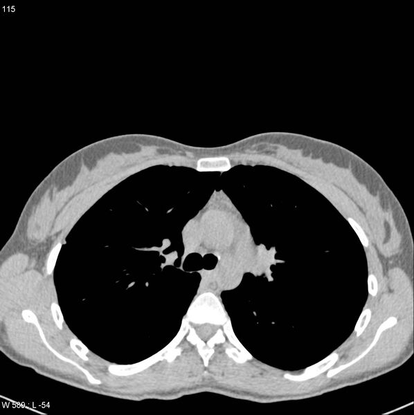 File:Catamenial pneumothorax (Radiopaedia 24847-25111 Axial non-contrast 1).jpg