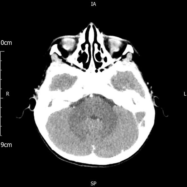 File:Cavernous sinus thrombosis (Radiopaedia 79414-92510 Axial Brain 69).jpg