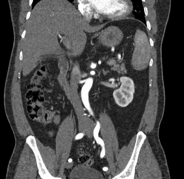 File:Celiac artery dissection (Radiopaedia 52194-58080 C 58).jpg