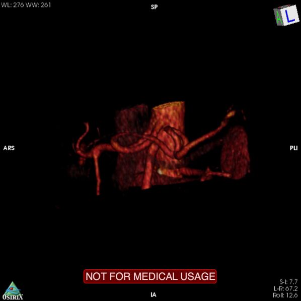 File:Celiac trunk variant anatomy - gastrohepatic trunk and splenic artery (Radiopaedia 38815-40995 B 23).jpg