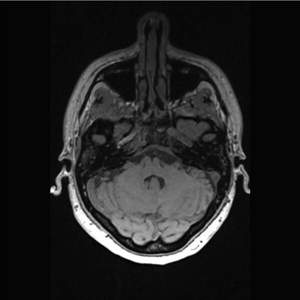 File:Central base of skull meningioma (Radiopaedia 53531-59549 Axial T1 2).jpg