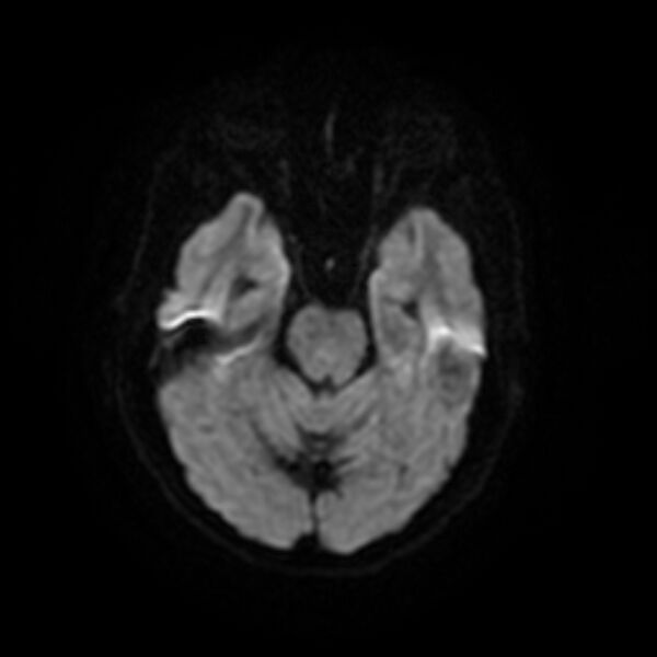 File:Central neurocytoma (Radiopaedia 67618-77021 Axial DWI 7).jpg
