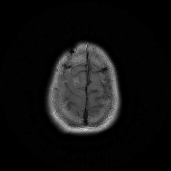 File:Central neurocytoma (Radiopaedia 67618-77021 Axial FLAIR 23).jpg
