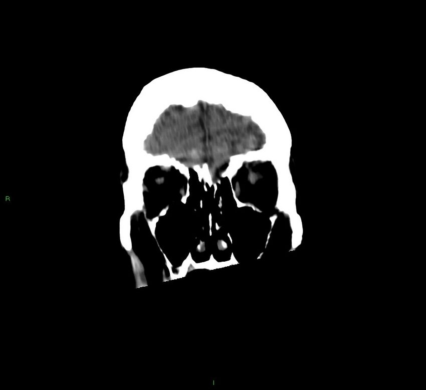 Cerebellar hemorrhage (Radiopaedia 58792-66026 Coronal non-contrast 53).jpg