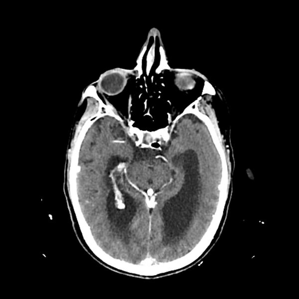File:Cerebellar metastasis - lung tumor (Radiopaedia 69317-79145 Axial with contrast 18).jpg
