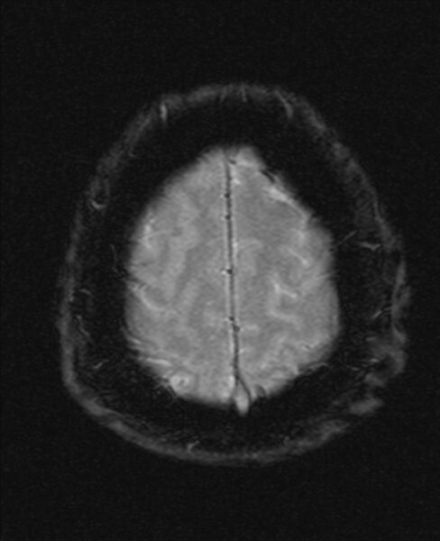 File:Cerebellopontine angle meningioma (Radiopaedia 24459-24764 Axial Gradient Echo 21).jpg