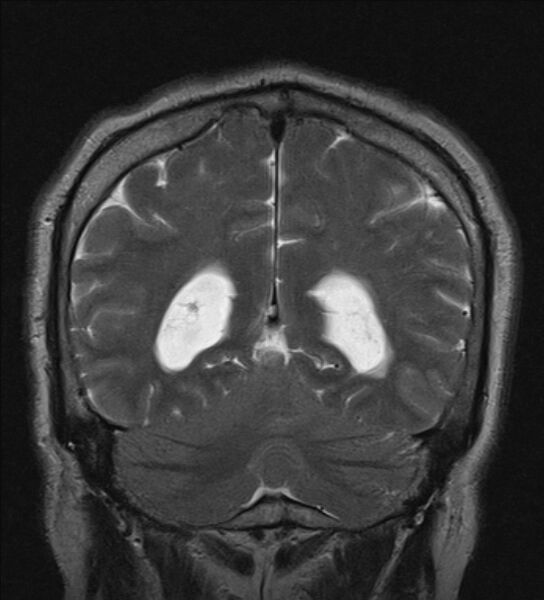 File:Cerebellopontine angle meningioma (Radiopaedia 24459-24764 Coronal T2 19).jpg
