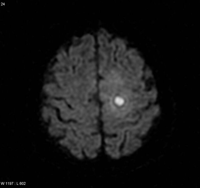File:Cerebral absceses (Radiopaedia 4933-6838 Axial DWI 1).jpg