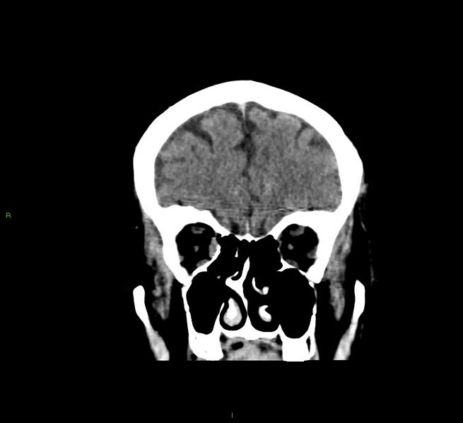 File:Cerebral amyloid angiopathy-associated lobar intracerebral hemorrhage (Radiopaedia 58376-65511 Coronal non-contrast 51).jpg