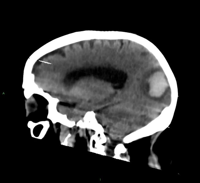 File:Cerebral amyloid angiopathy-associated lobar intracerebral hemorrhage (Radiopaedia 58377-65514 B 20).jpg
