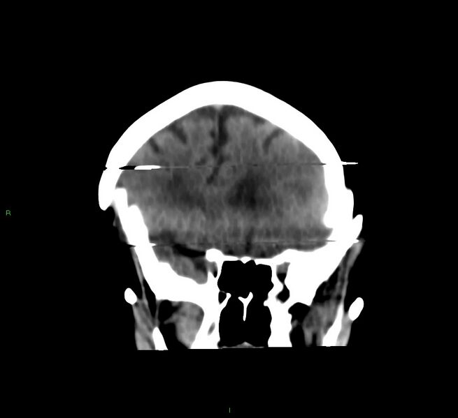 File:Cerebral amyloid angiopathy-associated lobar intracerebral hemorrhage (Radiopaedia 58377-65514 Coronal non-contrast 46).jpg