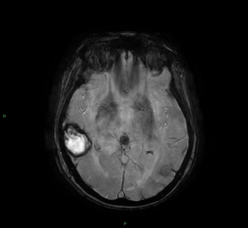 Cerebral amyloid angiopathy-associated lobar intracerebral hemorrhage (Radiopaedia 58378-65517 Axial SWI 34).jpg