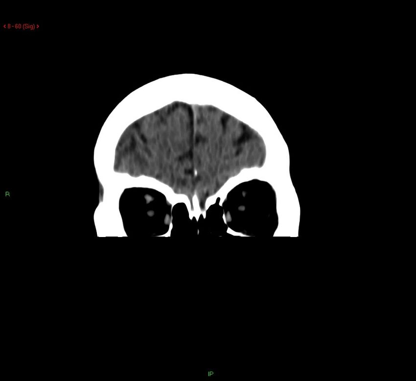 Cerebral amyloid angiopathy-associated lobar intracerebral hemorrhage (Radiopaedia 58378-65518 Coronal non-contrast 60).jpg