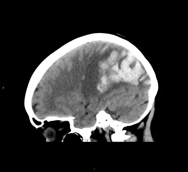 File:Cerebral amyloid angiopathy-associated lobar intracerebral hemorrhage (Radiopaedia 58563-65727 C 20).jpg