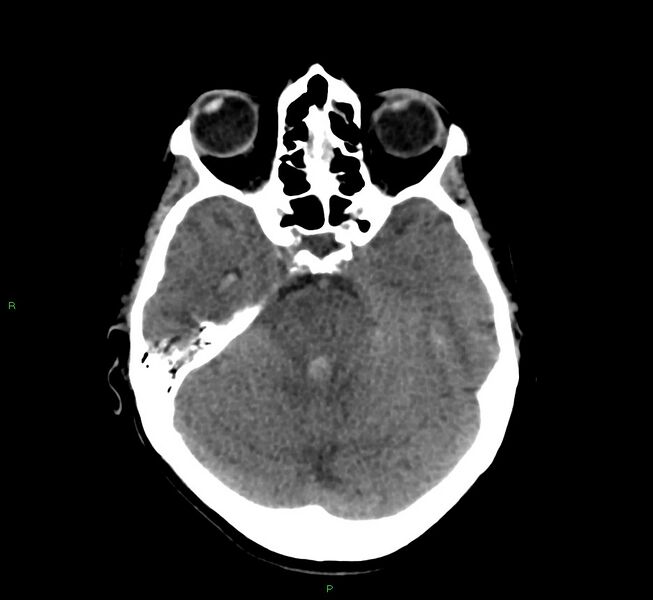 File:Cerebral amyloid angiopathy-associated lobar intracerebral hemorrhage (Radiopaedia 58566-65730 Axial non-contrast 35).jpg