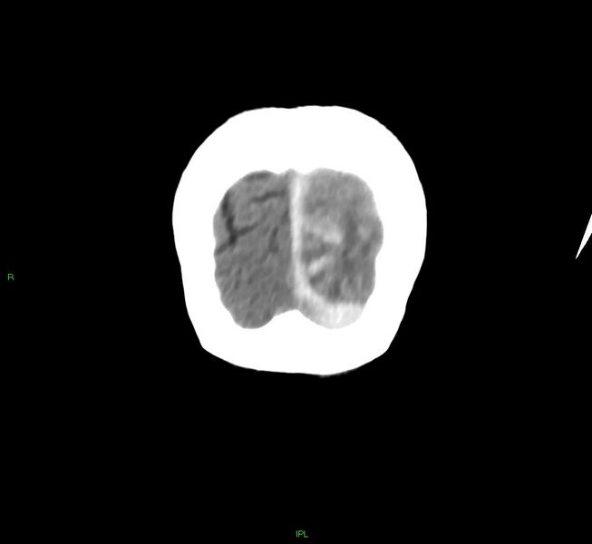 File:Cerebral amyloid angiopathy-associated lobar intracerebral hemorrhage (Radiopaedia 58754-65975 Coronal non-contrast 8).jpg