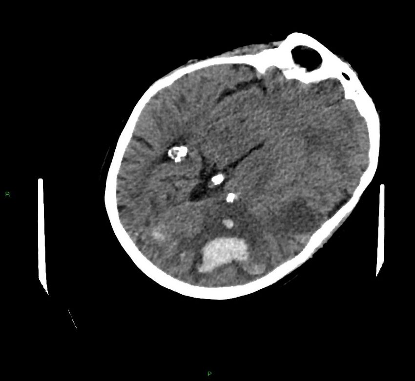 Cerebral amyloid angiopathy-associated lobar intracerebral hemorrhage (Radiopaedia 58757-65979 Axial non-contrast 53).jpg