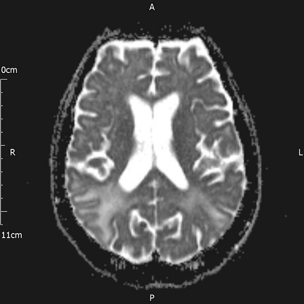 File:Cerebral amyloid angiopathy related inflammation (Radiopaedia 72772-83415 Axial ADC 14).jpg