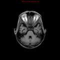 Cerebral and orbital tuberculomas (Radiopaedia 13308-13311 Axial T1 7).jpg
