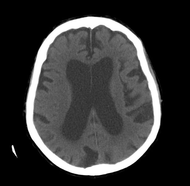 File:Cerebral atrophy (Radiopaedia 11287-11651 Axial 3).jpg