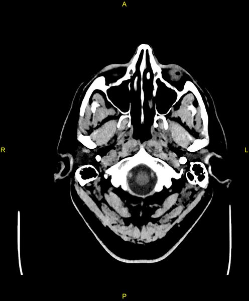 File:Cerebral autosomal dominant arteriopathy with subcortical infarcts and leukoencephalopathy (CADASIL) (Radiopaedia 86108-102051 Axial non-contrast 2).jpg