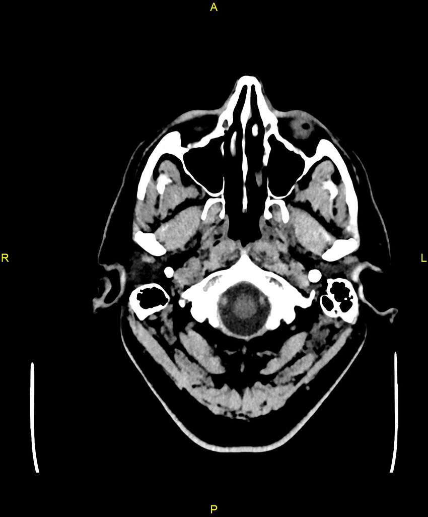 Cerebral autosomal dominant arteriopathy with subcortical infarcts and leukoencephalopathy (CADASIL) (Radiopaedia 86108-102051 Axial non-contrast 2).jpg