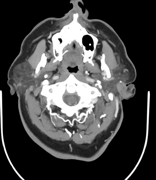 File:Cerebral dural venous sinus thrombosis (Radiopaedia 86514-102576 A 19).jpg