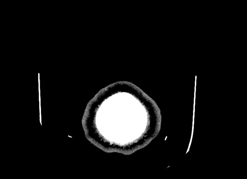 Cerebral edema (Radiopaedia 82519-96661 Axial non-contrast 2).jpg
