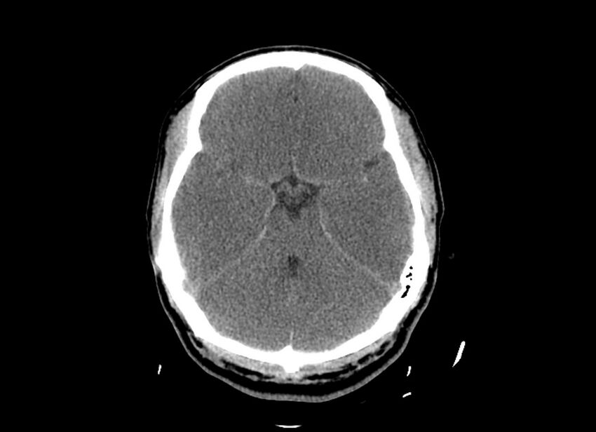 Cerebral edema (Radiopaedia 82519-96661 Axial non-contrast 36).jpg