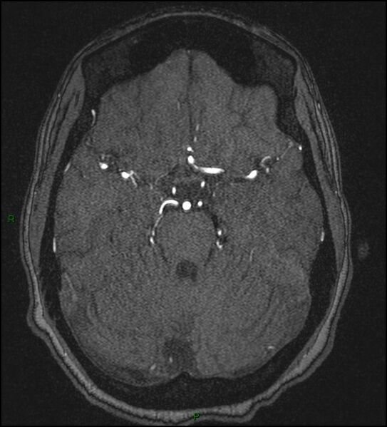 File:Cerebral fat embolism (Radiopaedia 35022-36525 Axial TOF 71).jpg
