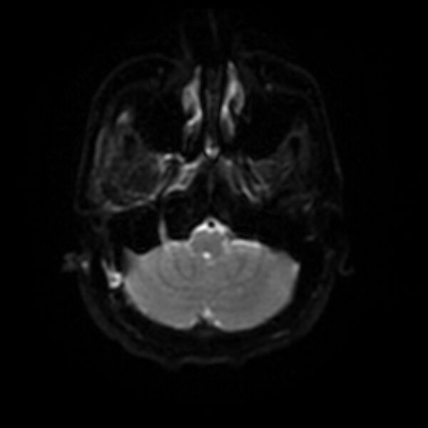 File:Cerebral fat embolism (Radiopaedia 37510-39363 Axial DWI 29).jpg