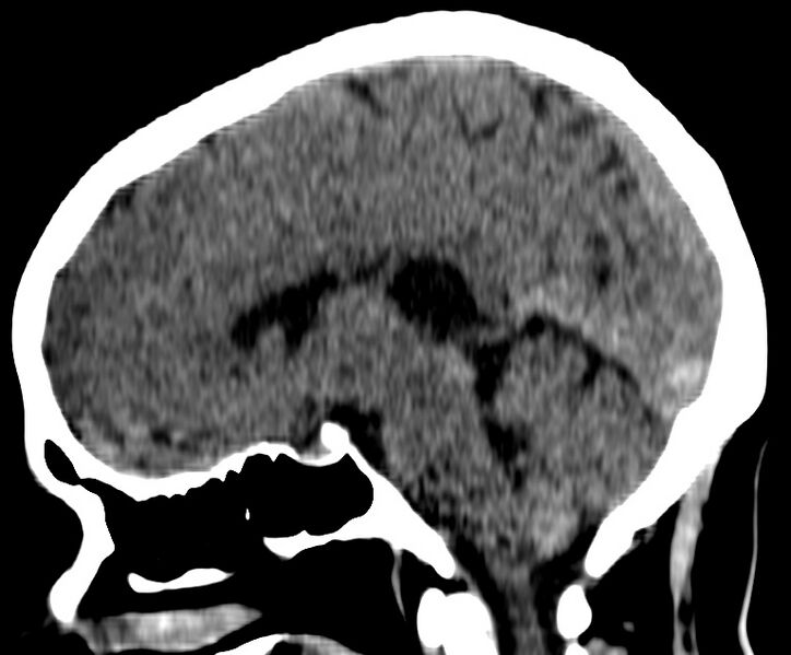 File:Cerebral venous thrombosis - CT only (Radiopaedia 41031-43778 B 19).jpg
