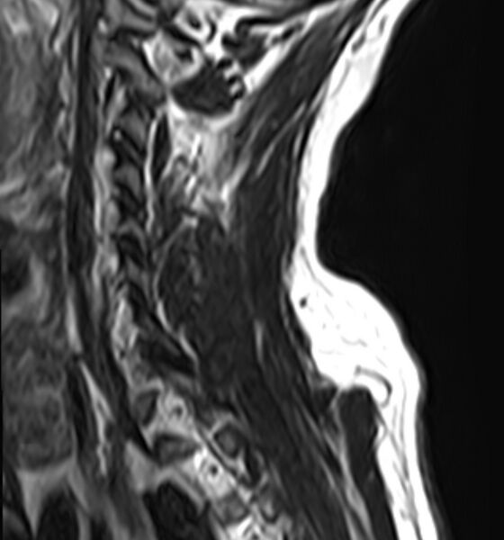 File:Cervical compressive myelopathy (Radiopaedia 71956-82411 C 11).jpg