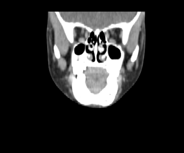 File:Cervical cystic lymphangioma (Radiopaedia 63655-72332 Coronal + contrast 11).jpg
