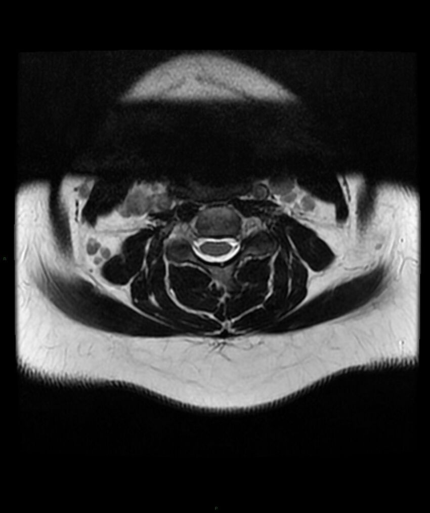 Cervical disc prolapse (Radiopaedia 80258-93598 Axial T2 21).jpg