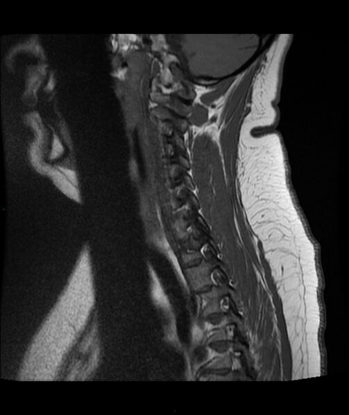 File:Cervical disc prolapse (Radiopaedia 80258-93598 Sagittal T1 4).jpg